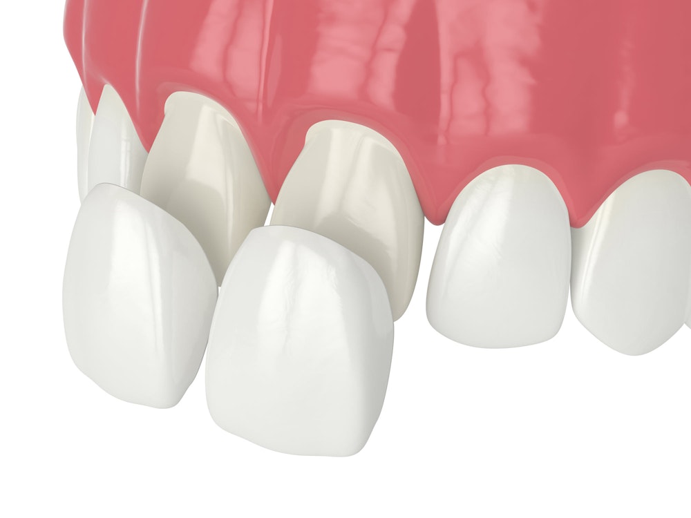 illustration of a porcelain veneer being placed over a front tooth