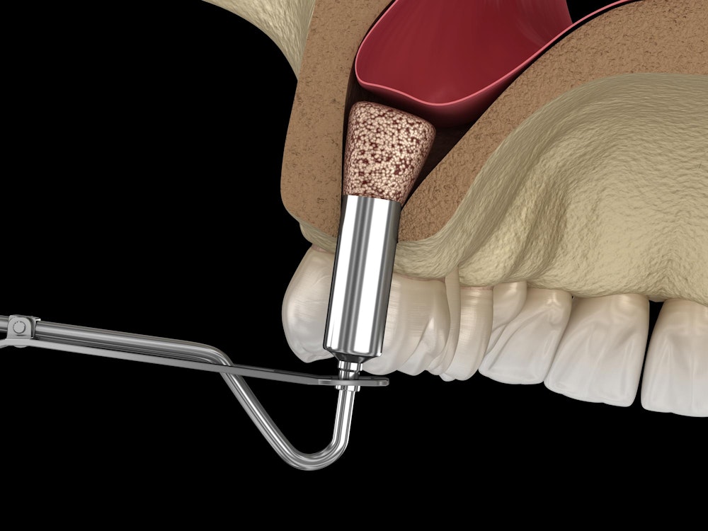 Sinus lift
