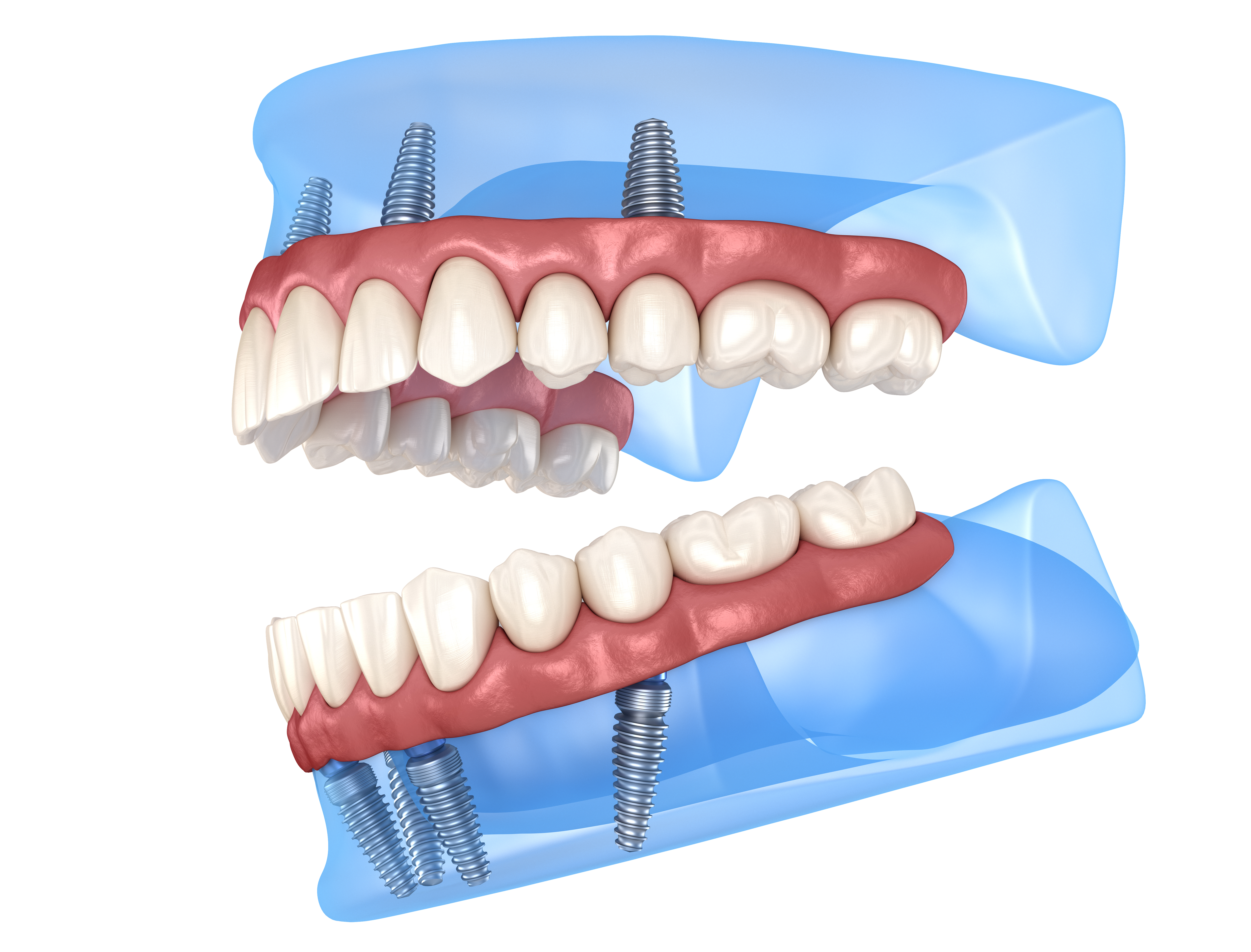 3d image of dental implants