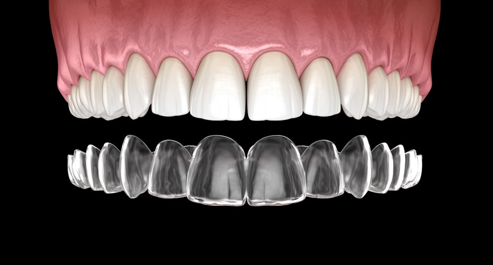clear aligners