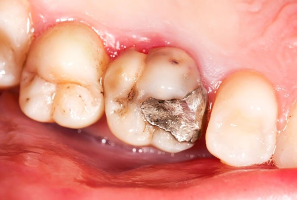 Dental decay