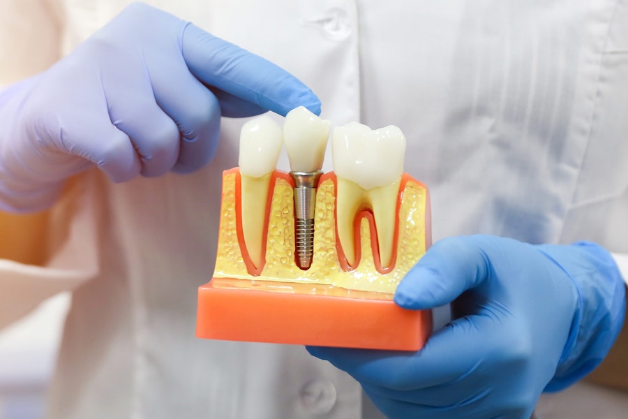 dentist holding model of dental implant in jaw