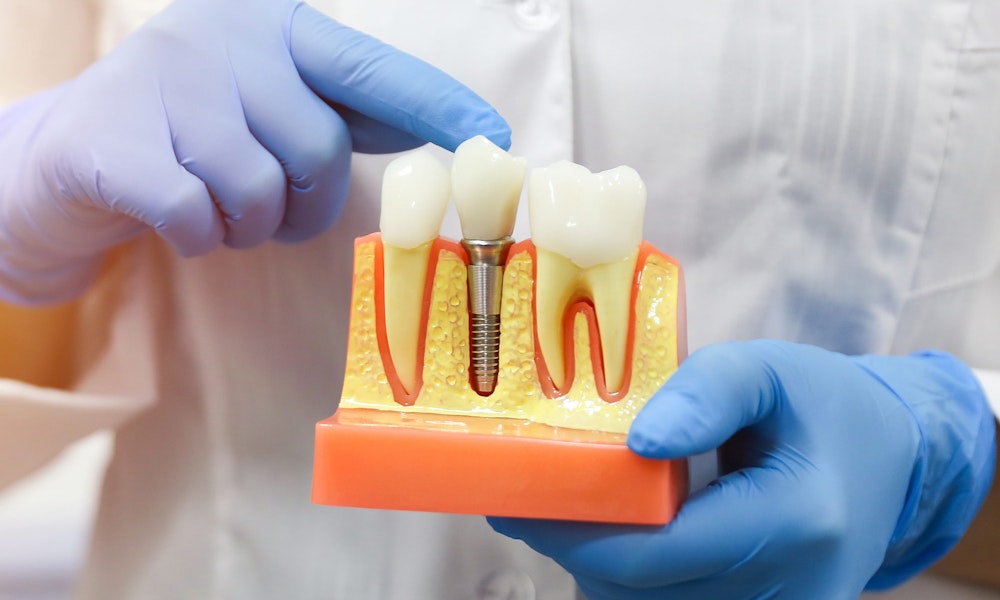 dentist holding model of dental implant in jaw