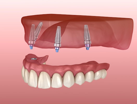 all-on-4 dental implants