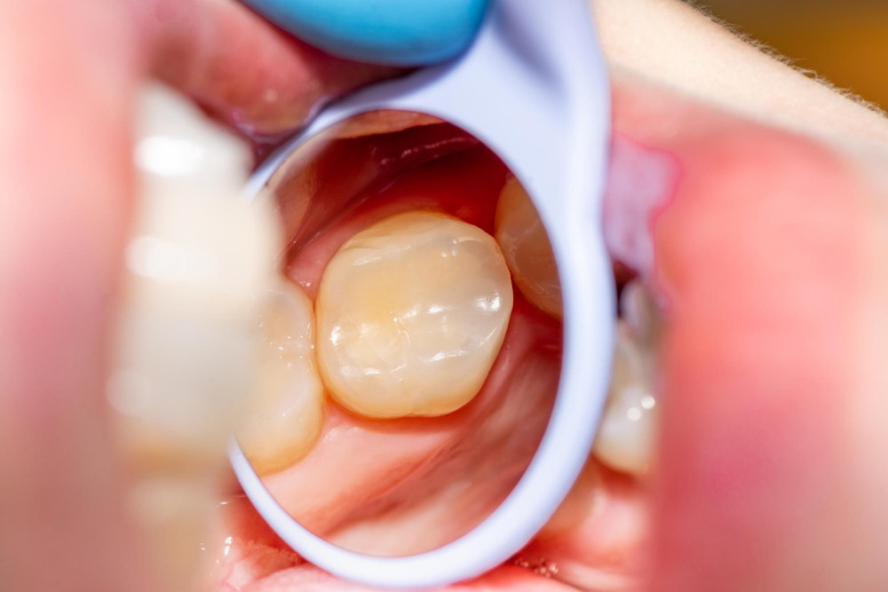 Tooth-colored filling