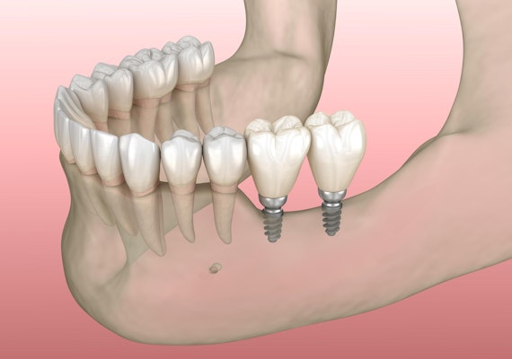 miniature dental implant