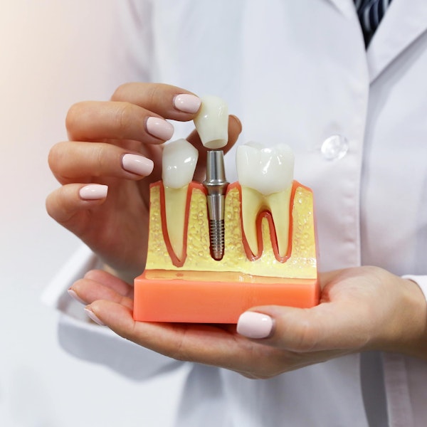 Dental Implant model