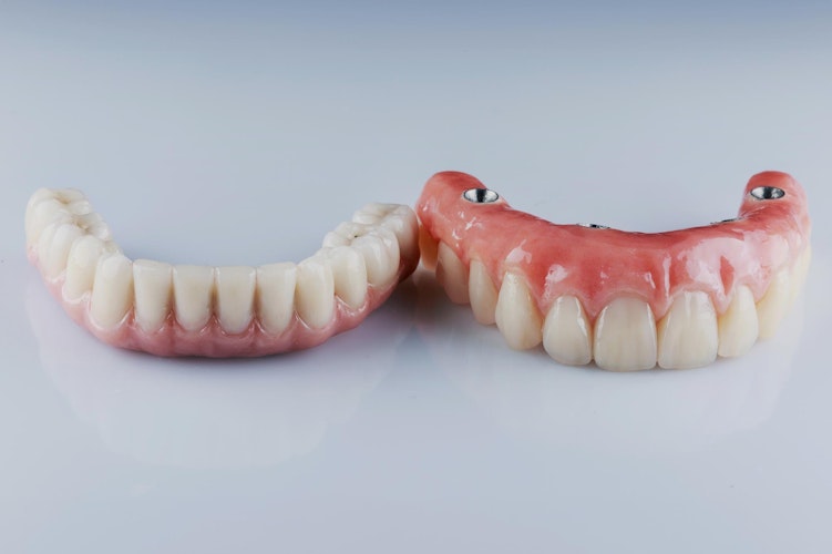 an implant denture for a full arch