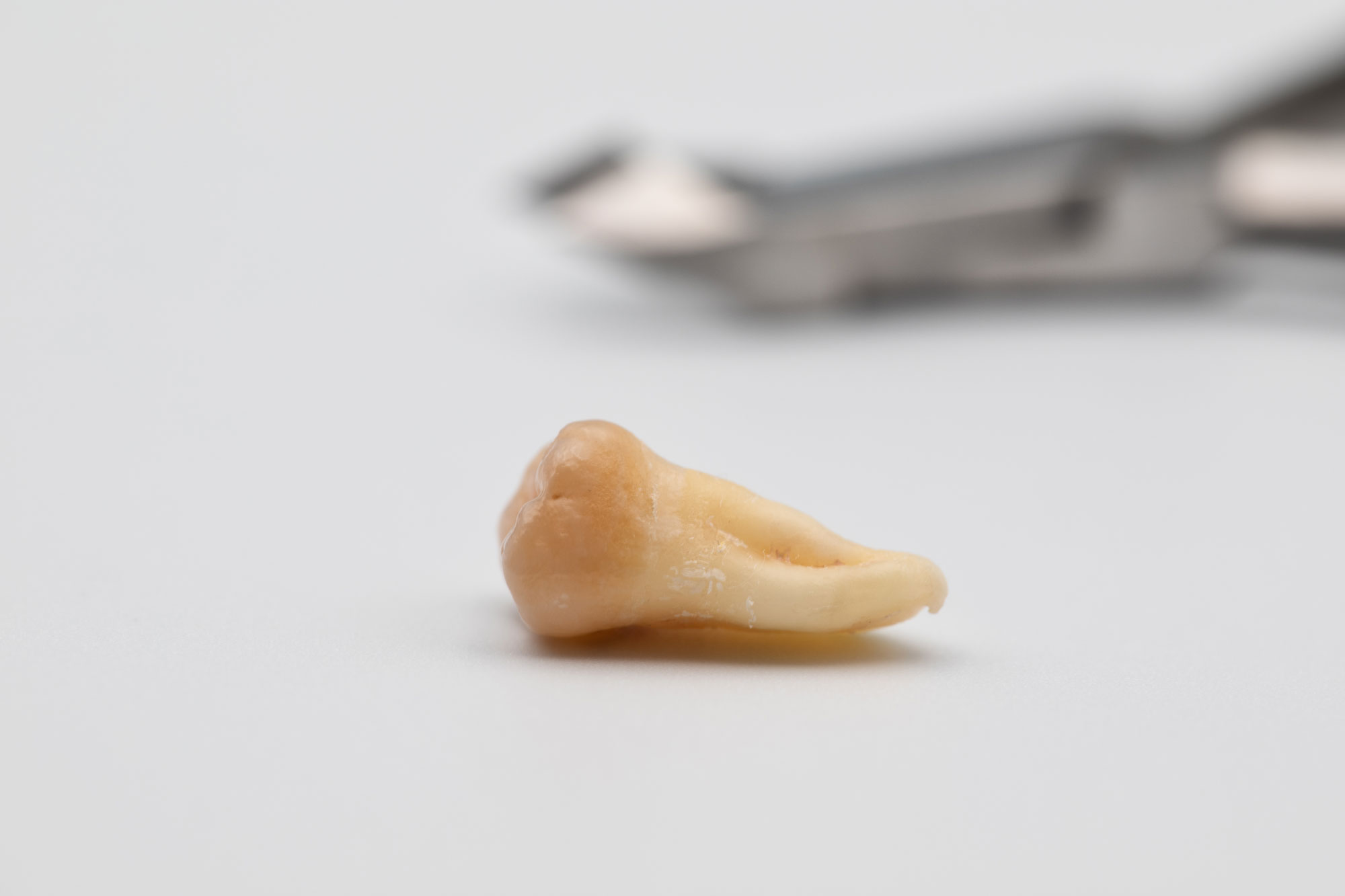 extracted wisdom tooth