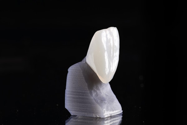 Dental crown for a front tooth