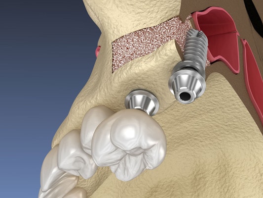 Sinus lift procedure