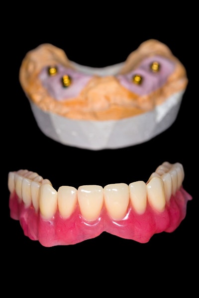 All-on-4 Dental Implant