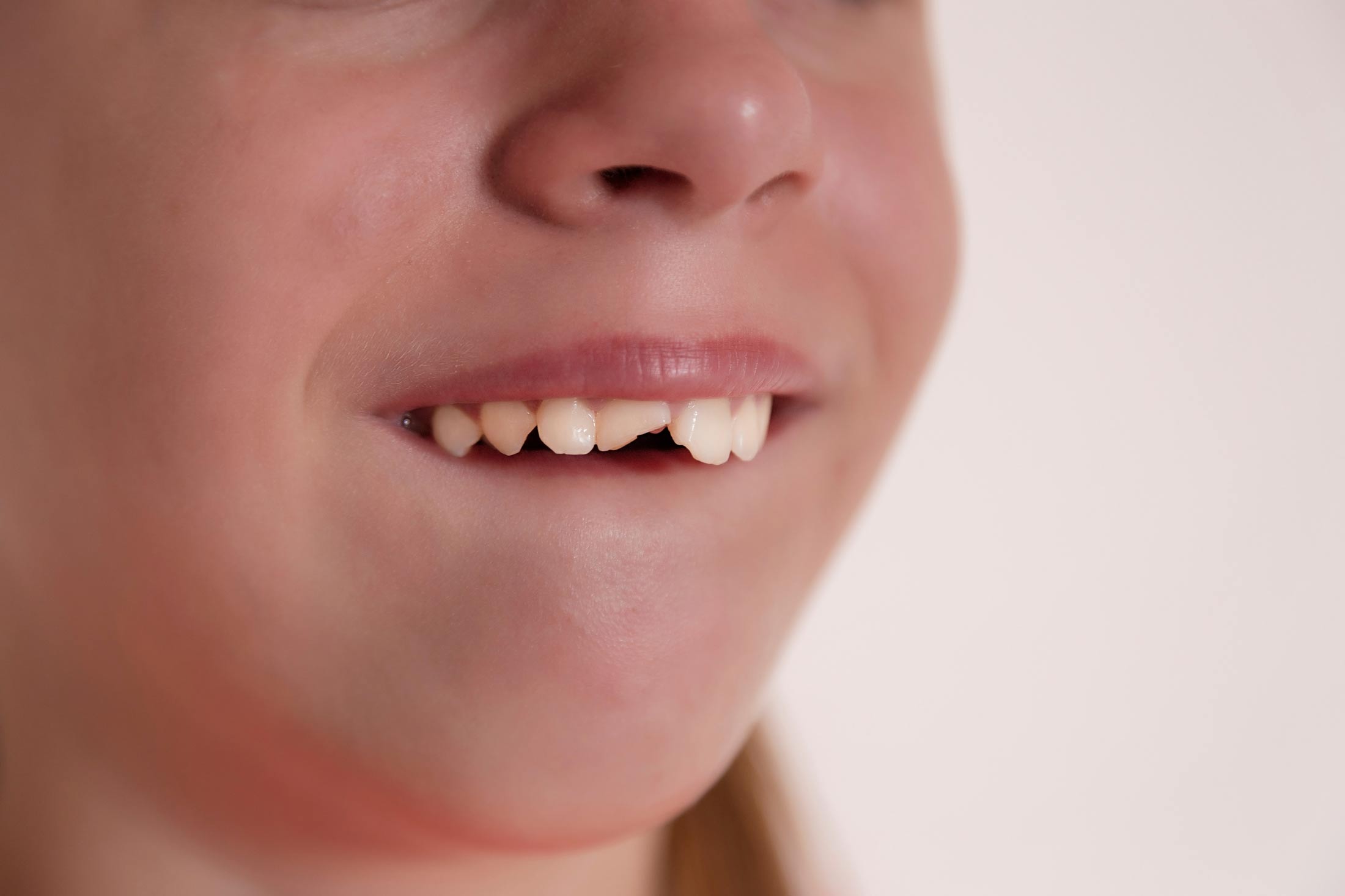Child with broken front tooth