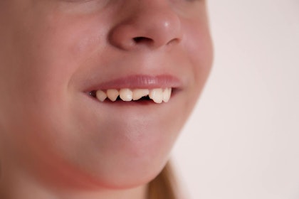 Child with broken front tooth
