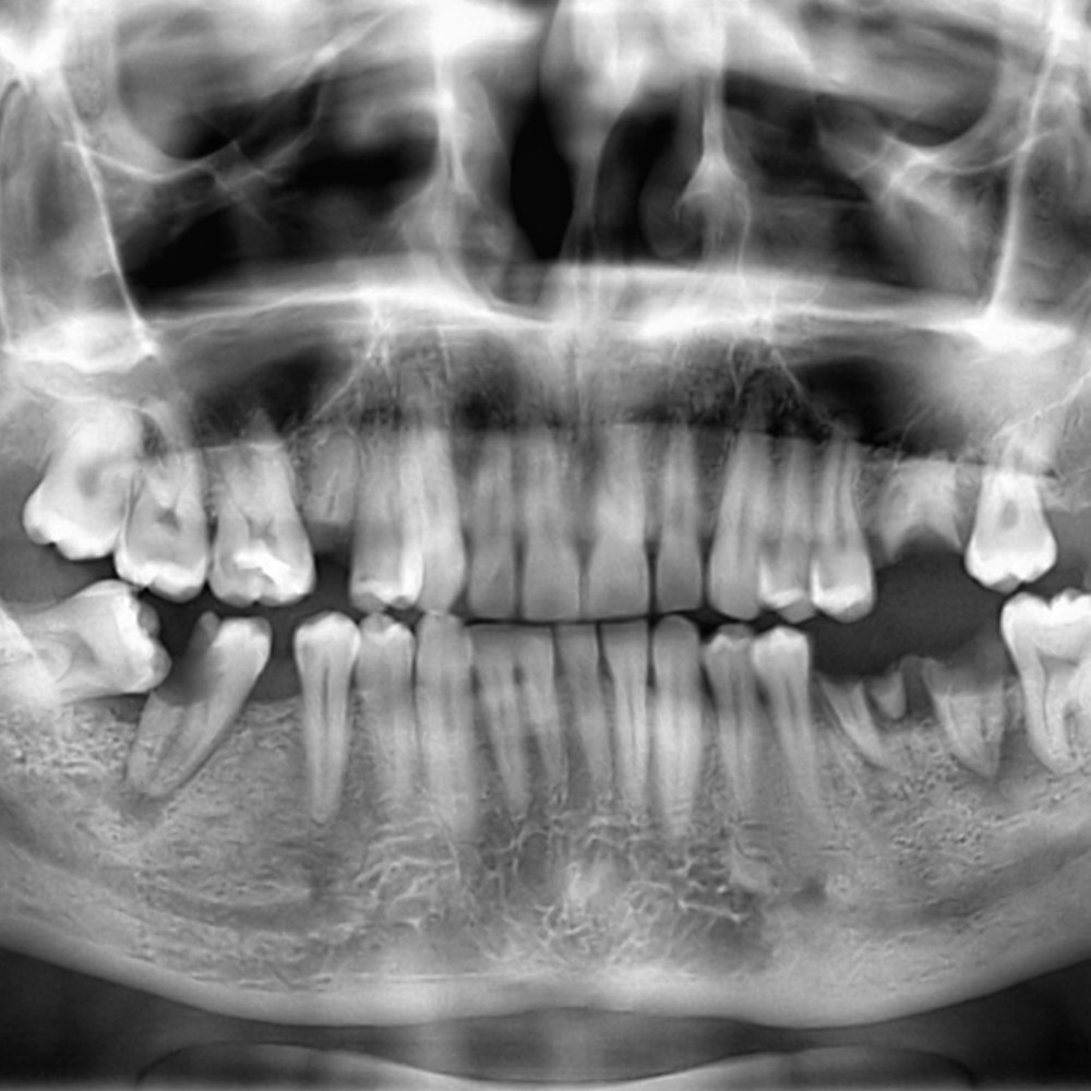 Pen pointing to x-ray of jaw
