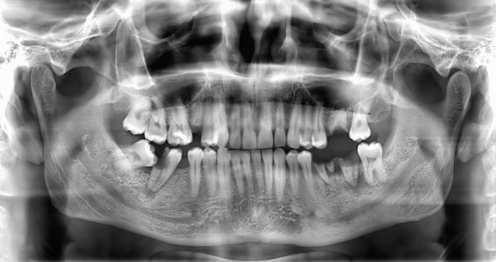Pen pointing to x-ray of jaw