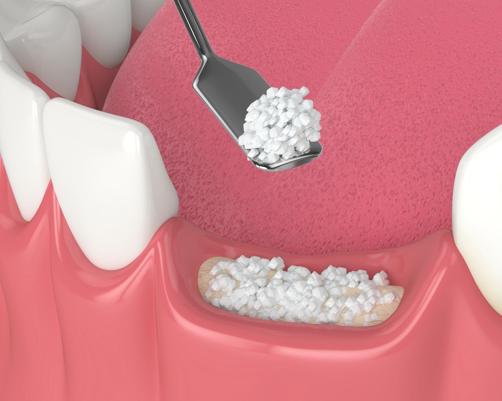bone material being added to the jaw