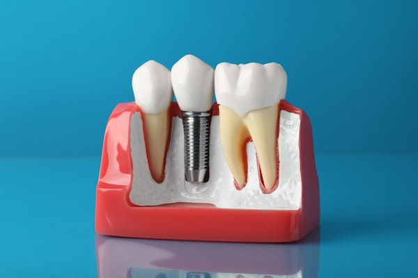 Dental implant model