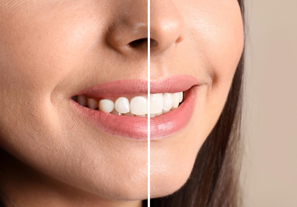 Smile before and after gum contouring