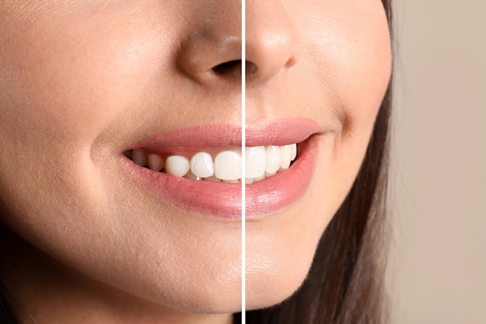 Crown lengthening before and after