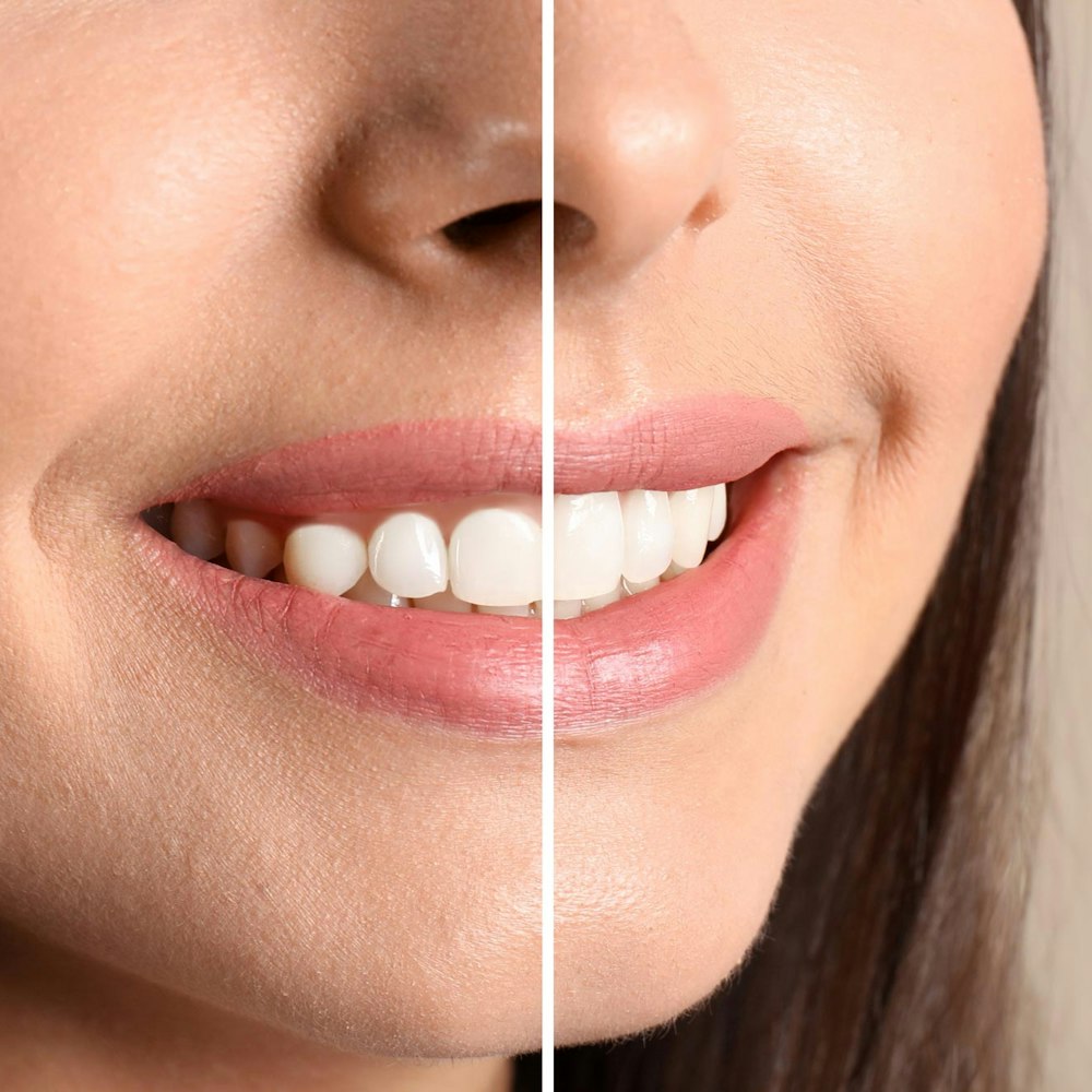 Crown lengthening before and after