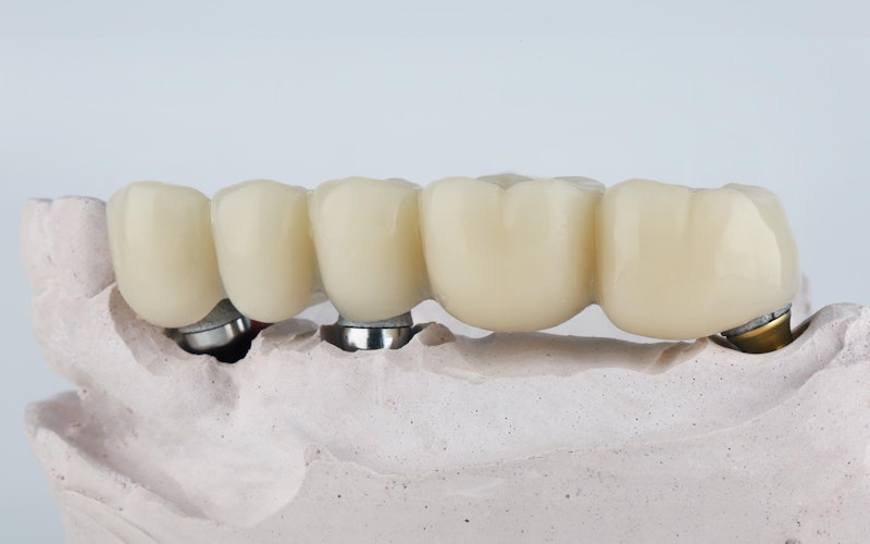 a dental bridge supported by implants