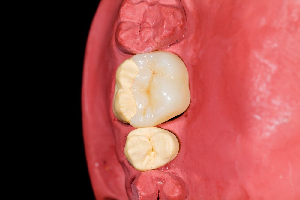 Causes and Signs of Damaged Fillings - Bismarck, ND