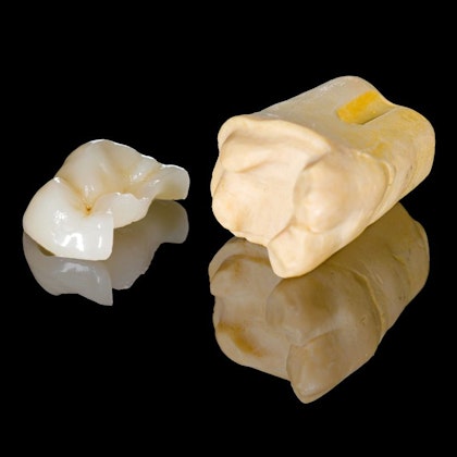 Inlay and model of tooth
