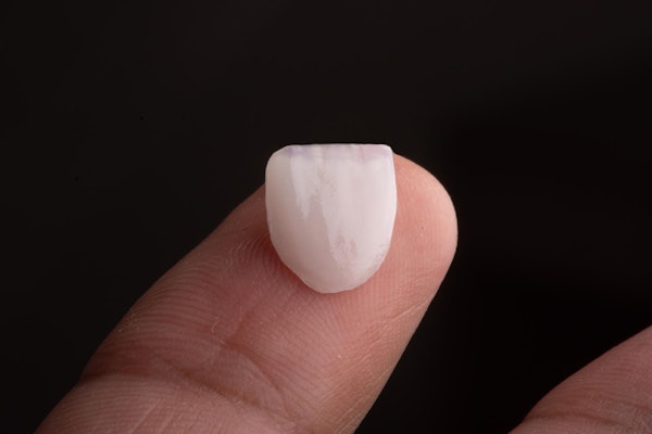 ultra-thin no-prep veneer