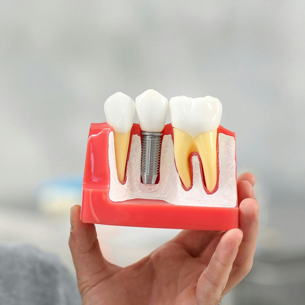 Model of dental implant in jaw