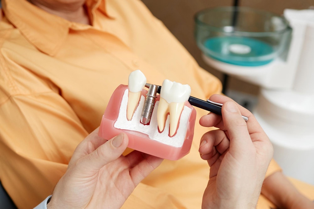 Dental implants