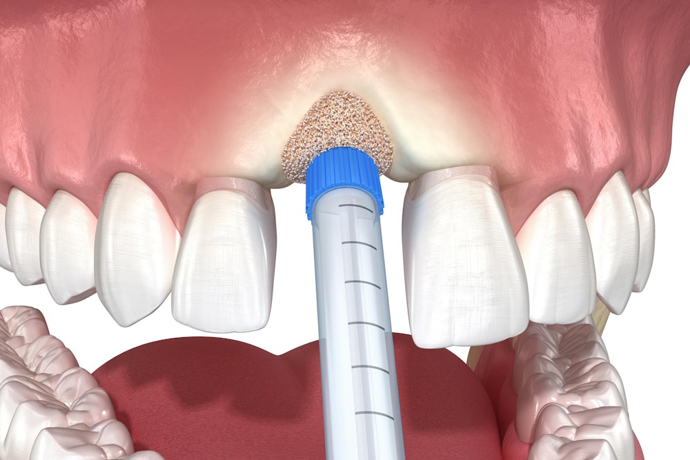 bone graft illustration