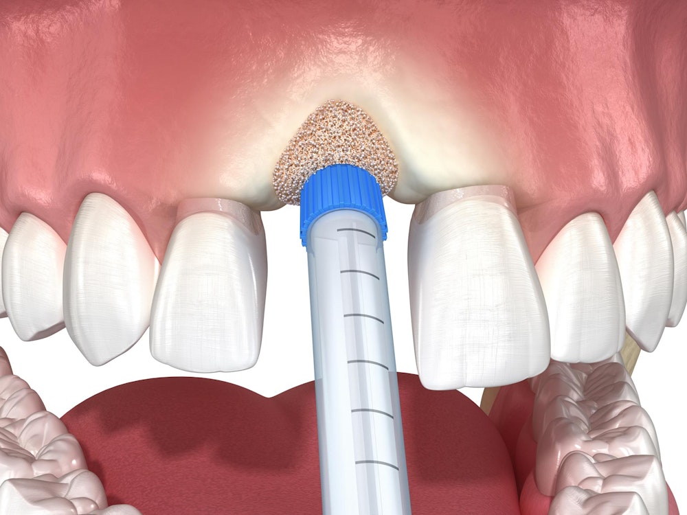 bone graft illustration