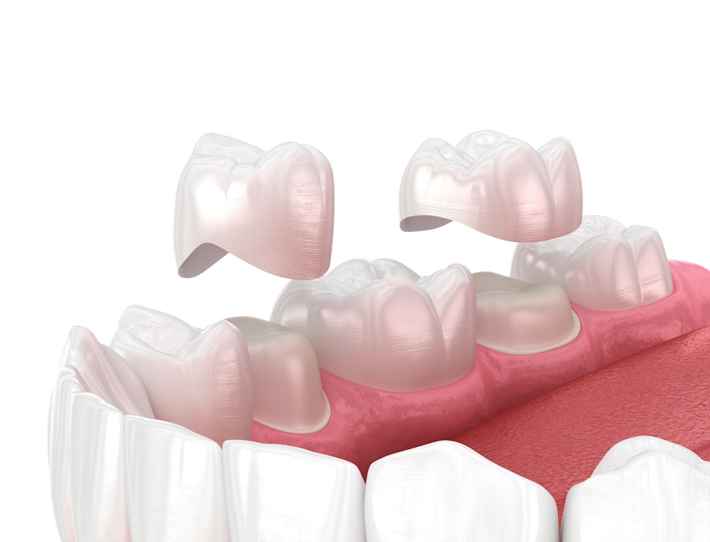 Dental crowns