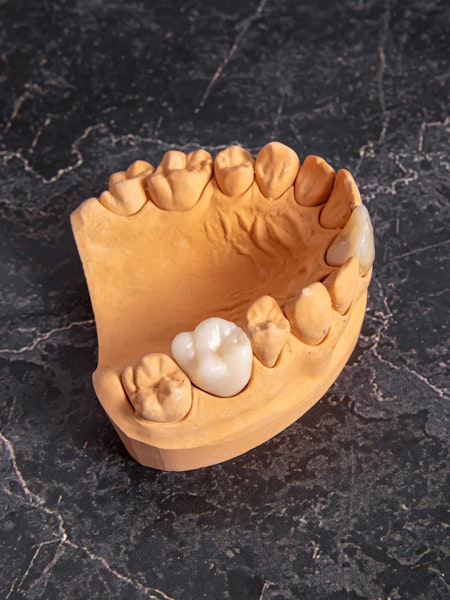 Dental crowns and model of teeth