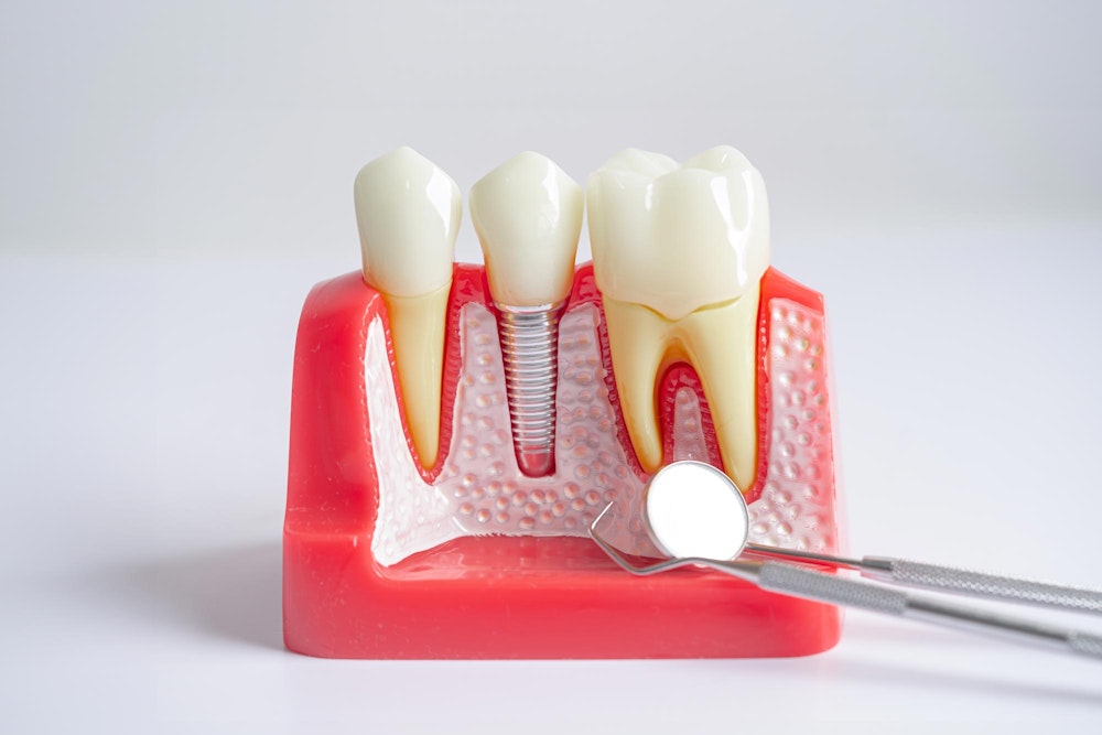 Model of jaw and implant next to dental instruments