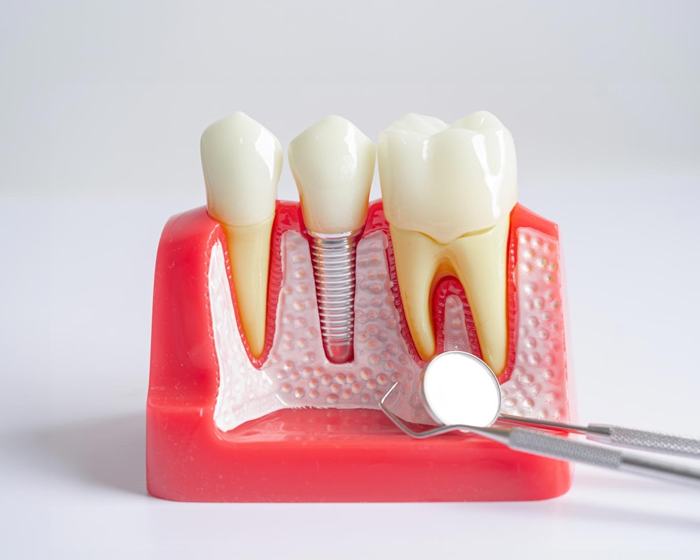Implant-supported crown model with dental tools