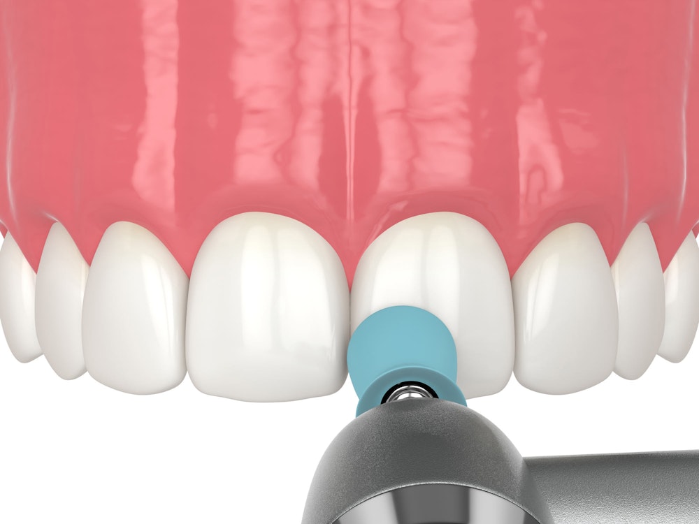 dental bonding illustration