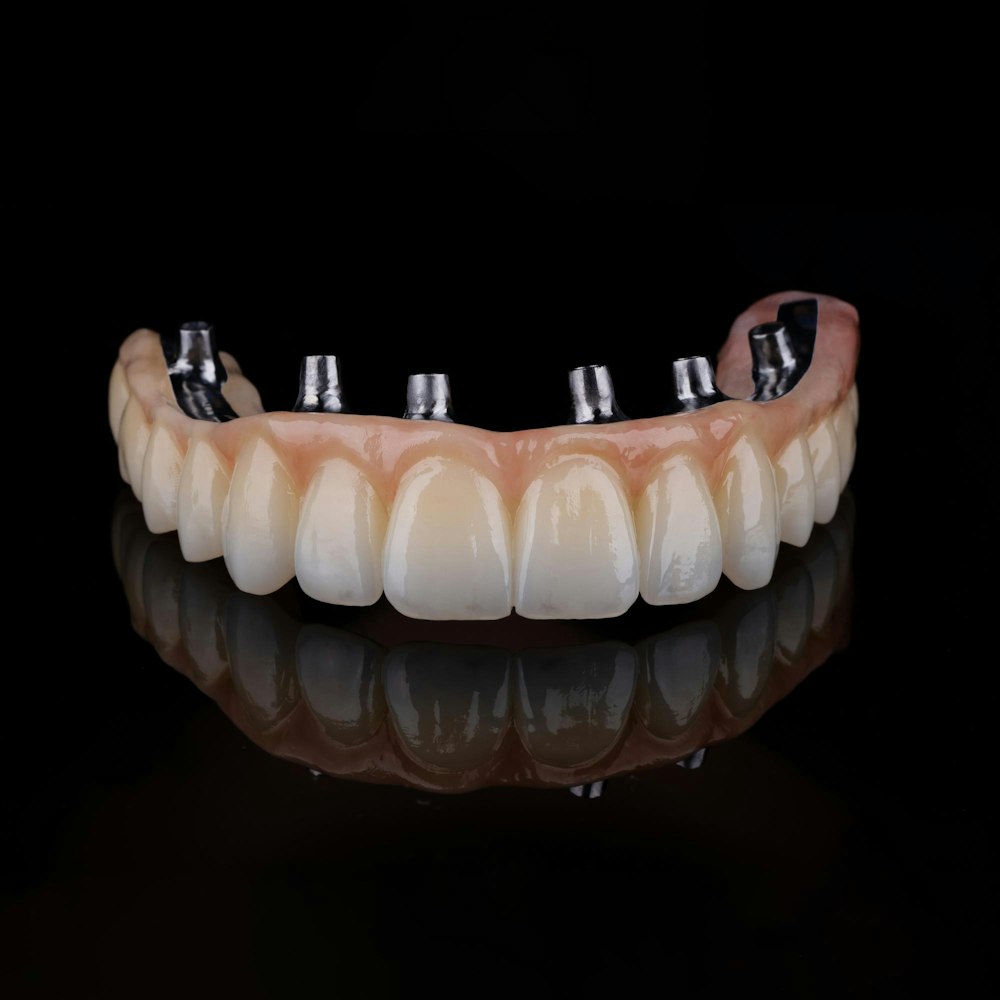 Illustration of an implant-supported denture