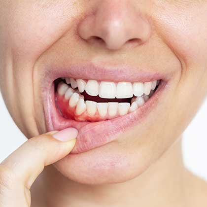 Woman with inflamed gums