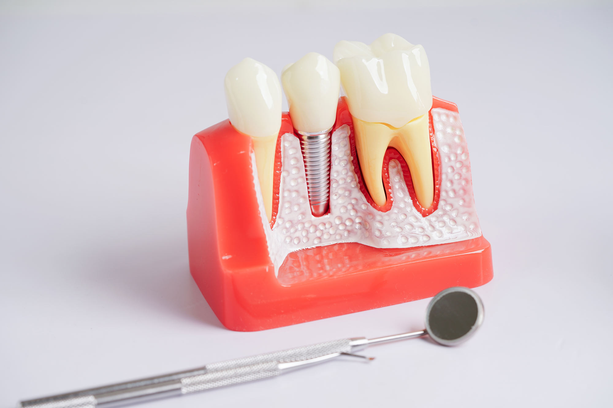 Dental Implant