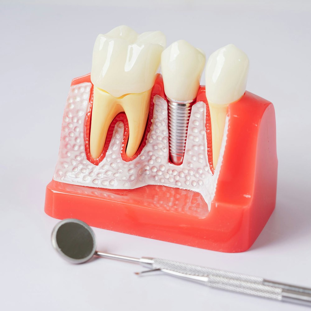Dental Implant