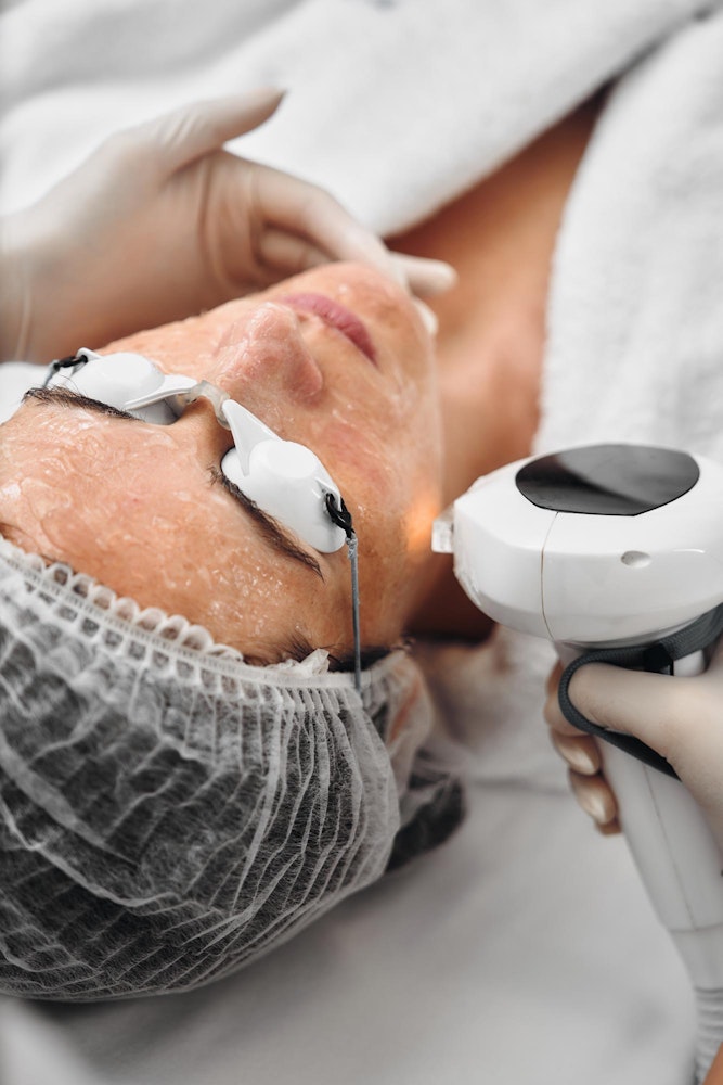 Woman receiving an IPL Photofacial