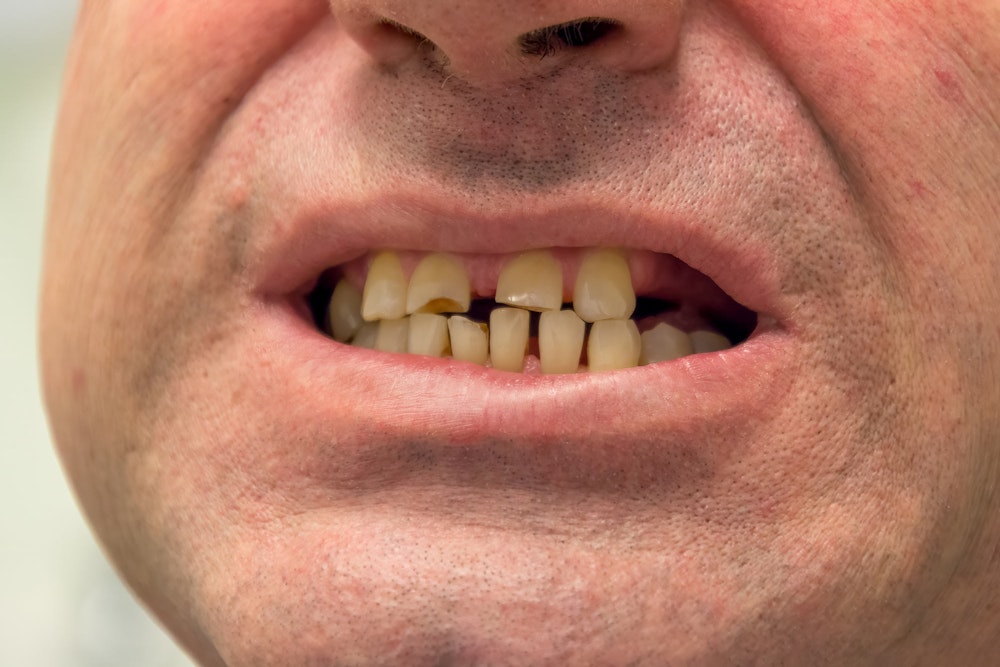 teeth worn from chewing