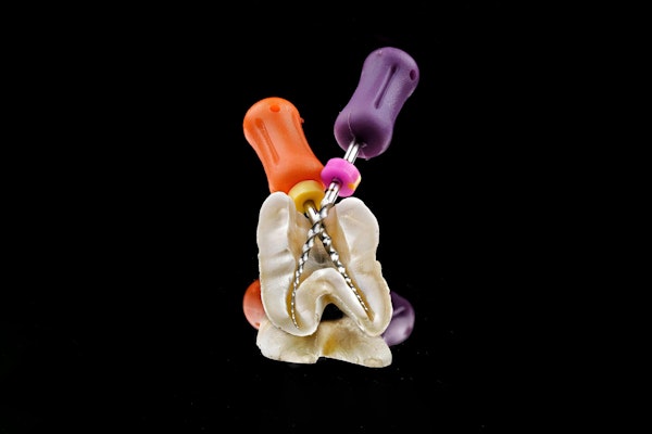 root canal diagram