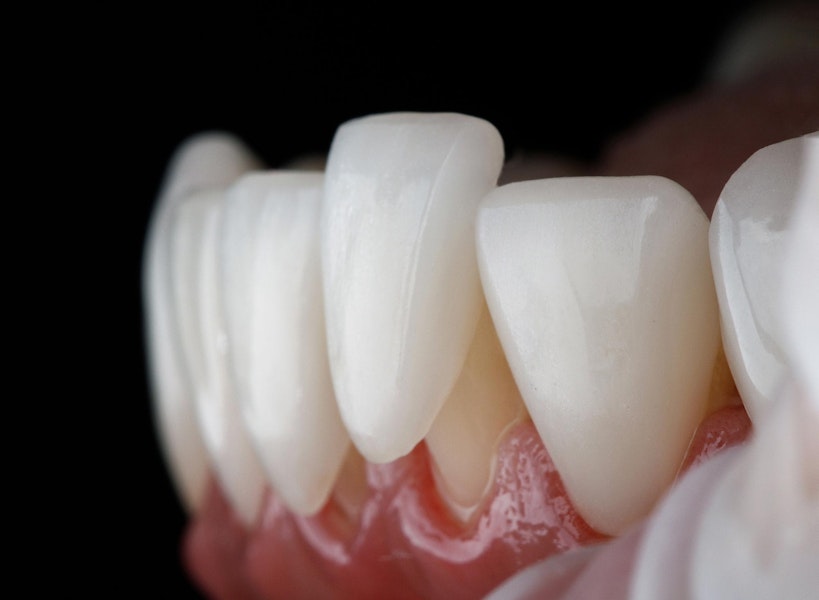a porcelain veneer being placed over a lower front tooth