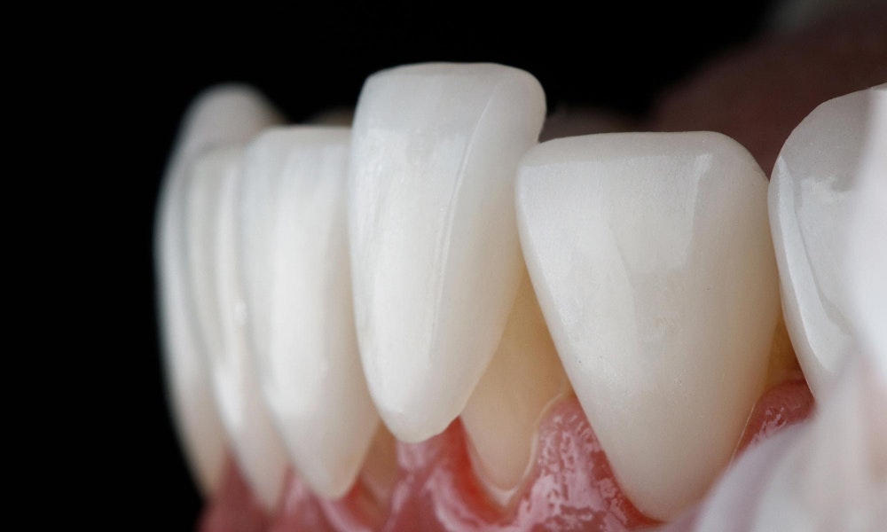 a porcelain veneer being placed over a lower front tooth