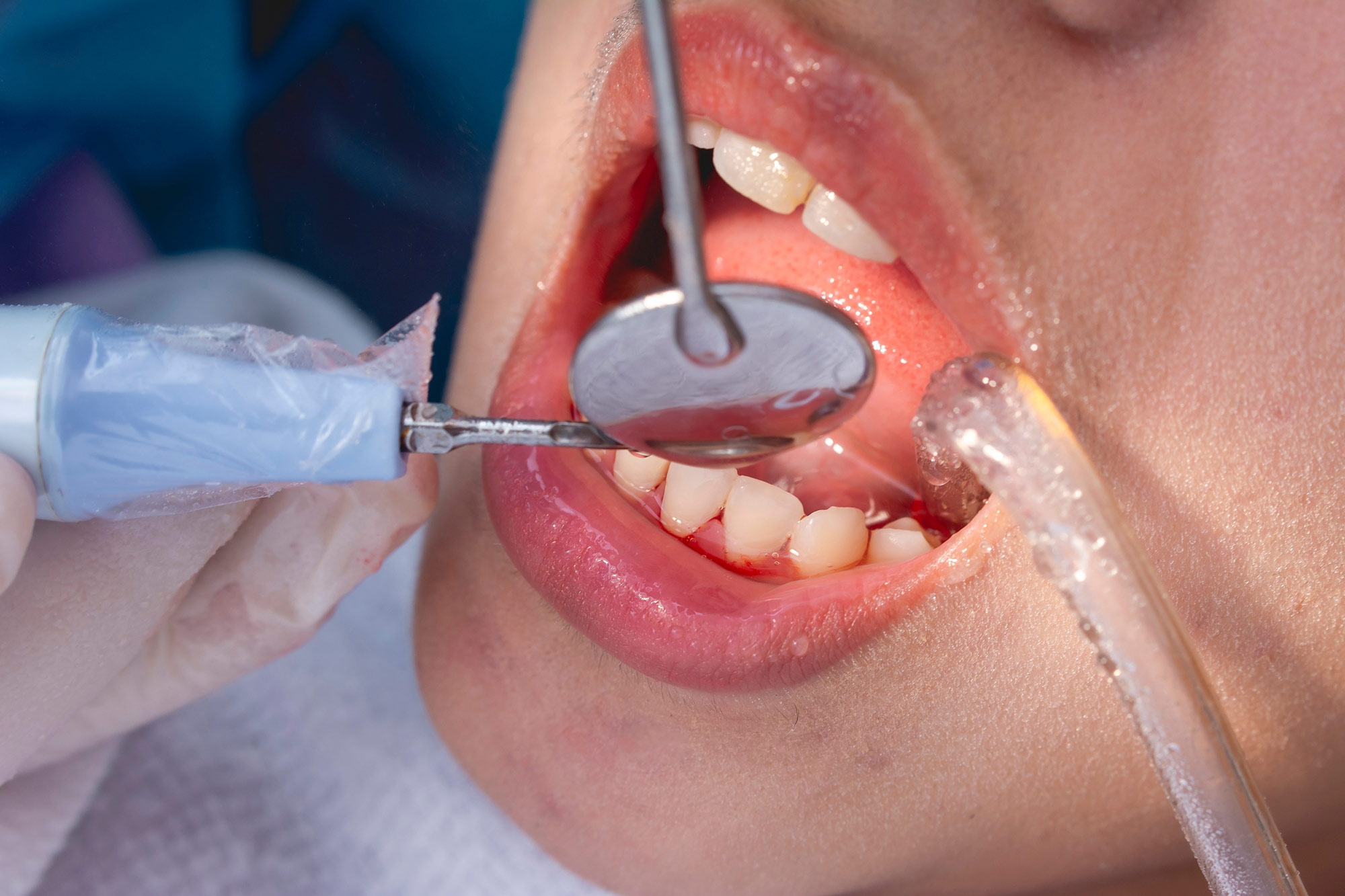 Periodontics Redlands, CA - Highland, CA - Loma Linda, CA
