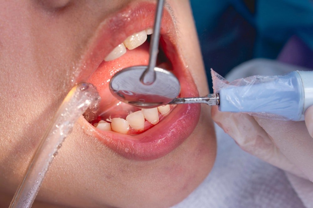 Scaling and root planing