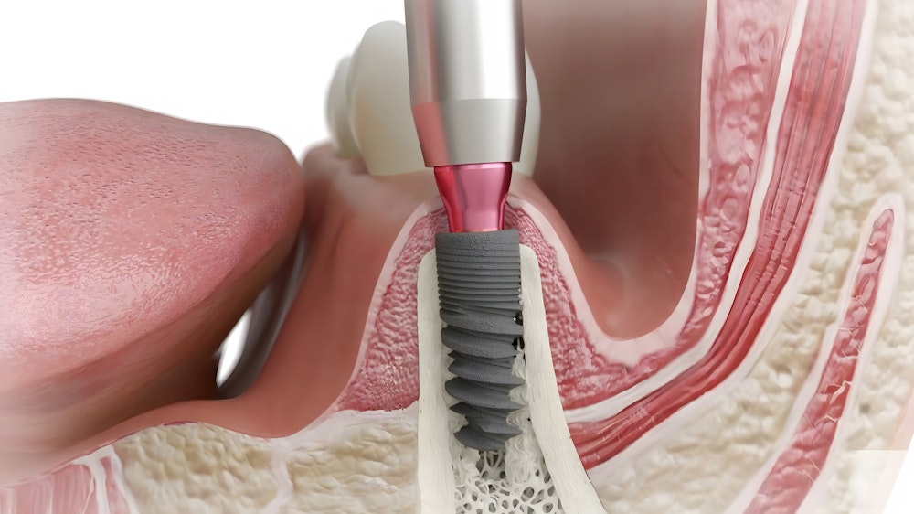 dental implant in a jawbone